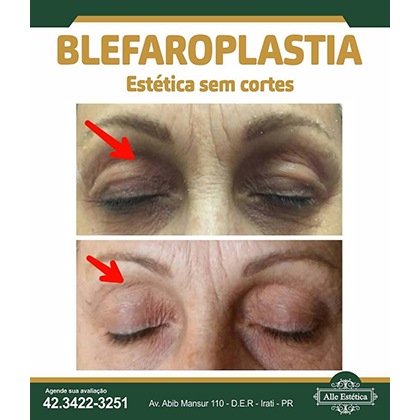 Blefaroplastia sem cortes