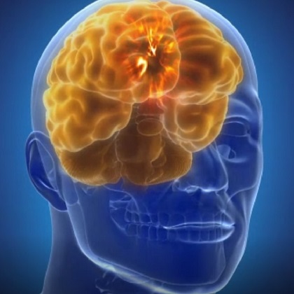 Mal de Parkinson e o marcapasso cerebral que promete acabar com tremores e convulsões causados pela doença